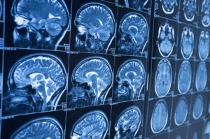 Most Common Types of Brain Injuries