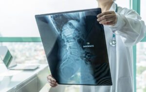 What Can Hammers Car Accident & Personal Injury Lawyers Do for Me Following a Spinal Cord Injury in Atlanta, GA?