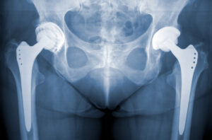 What Is a Hip Fracture?