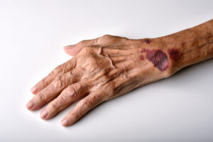 What Is a Soft Tissue Injury?
